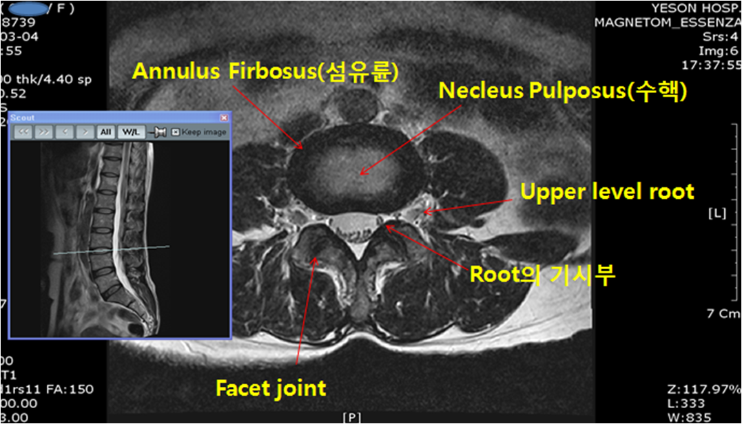 디스크, 수핵탈출증(HNP.HIVD), 요추간판탈출증의 원인, 증상, 추간판탈출증의 치료방법, 약, 주사, 신경치료, 보호대, 시술, 추간판탈출증의 수술·완치·후기.