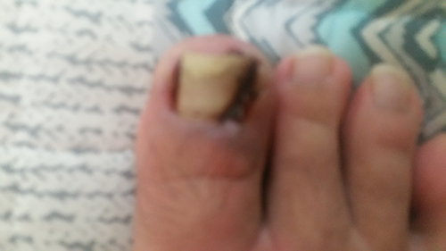 염증이 없는 발톱내성 발톱파기