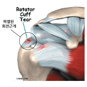 부천 회전근개건염과 손상, 팔이 올라가지 않는 어깨 염증 증상을 방치하면 파열됩니다.