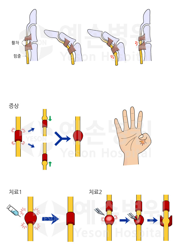 방아쇠수지-로고바꿈.jpg