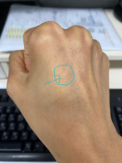 손등 통증이 계속 발생하는 이유 류마티스내과의원 류마티스내과에서 검사를 해봐야지!