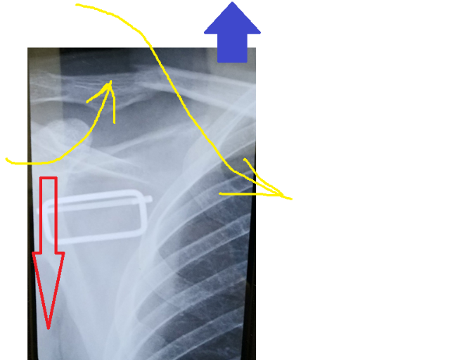 clavicle.png