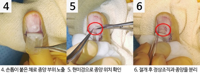 사구체종양수술과정_04-06.jpg