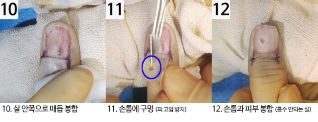 사구체종양수술과정_10-12.jpg