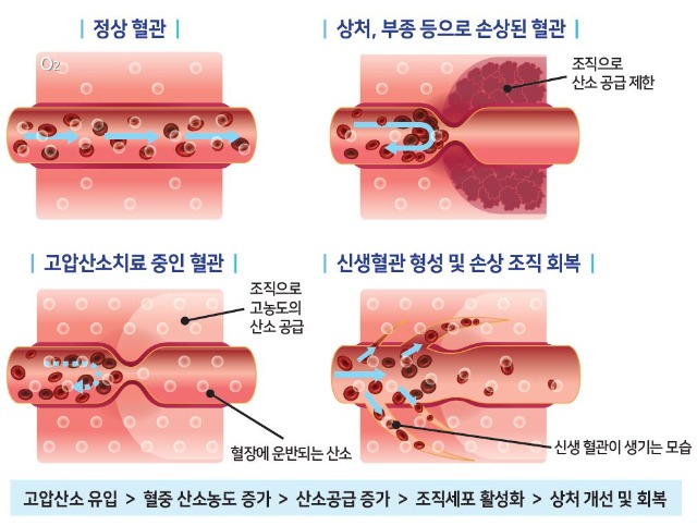 고압산소치료의원리_예손수정_제목없음.JPG