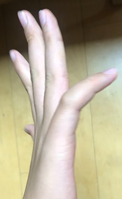 새끼손가락 힘줄손상으로 수술 - 전문의상담 새끼손가락 힘줄손상으로 수술 - 전문의상담