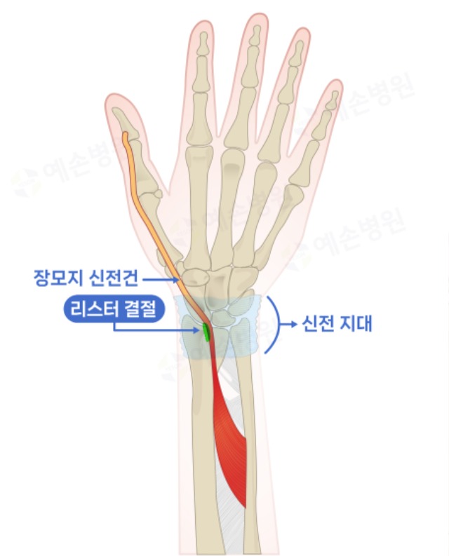 230209_팔뼈.jpg