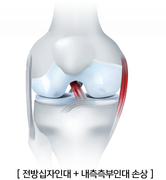 무릎 인대손상 - 다양한 인대손상 - 예손 의학정보
