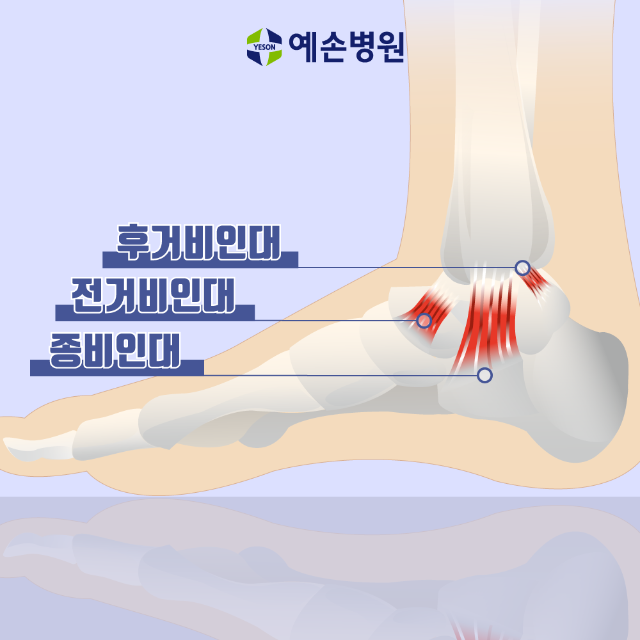 발목인대 파열, 최소침습 인대봉합술 - 예손 의학정보